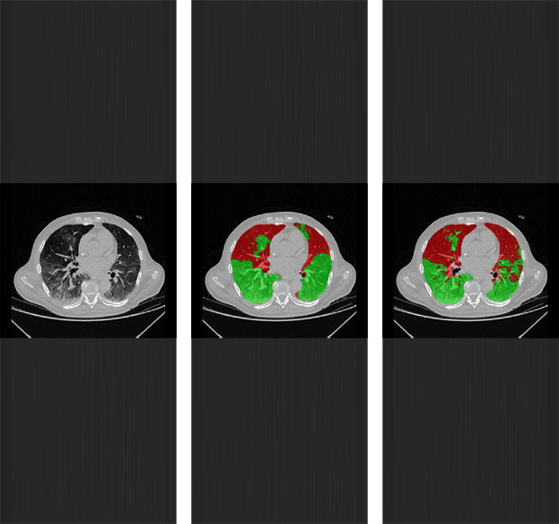 Imagens de tomografia computadorizada do pulmão