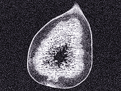 Corte tomográfico sagital mostra fruto íntegro (à esquerda) e região impactada.