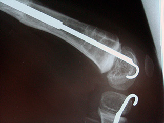 Haste usada nos procedimentos cirúrgicos: resultados revelam grande sobrevida de implantes (Foto: Divulgação)