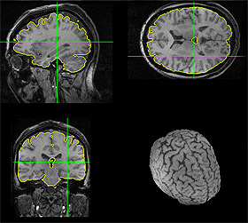 Imagens geradas pelo programa Bia (Brain Image Analyzer), que realiza dissecações virtuais: primeira versão do software está prevista para fevereiro de 2010 (Foto: Antoninho Perri) 