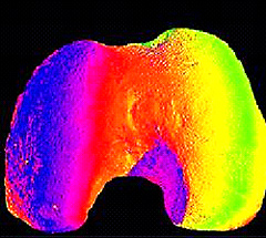 Imagem tridimensional da extremidade do fêmur gerada pelo processo de Moiré 