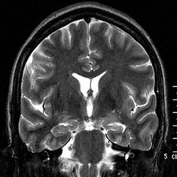 Imagens de ressonância magnética evidenciando atrofia hipocampal esquerda (indicada pela seta) em um paciente com ELTM esporádica 