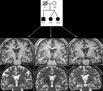 Imagens de ressonância magnética evidenciando atrofia hipocampal esquerda (indicada pela seta) em um paciente com ELTM esporádica 
