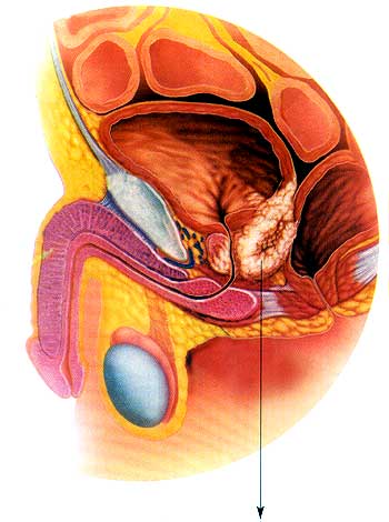 Ilustração mostra o câncer prostático T4, que acomete o reto e a bexiga