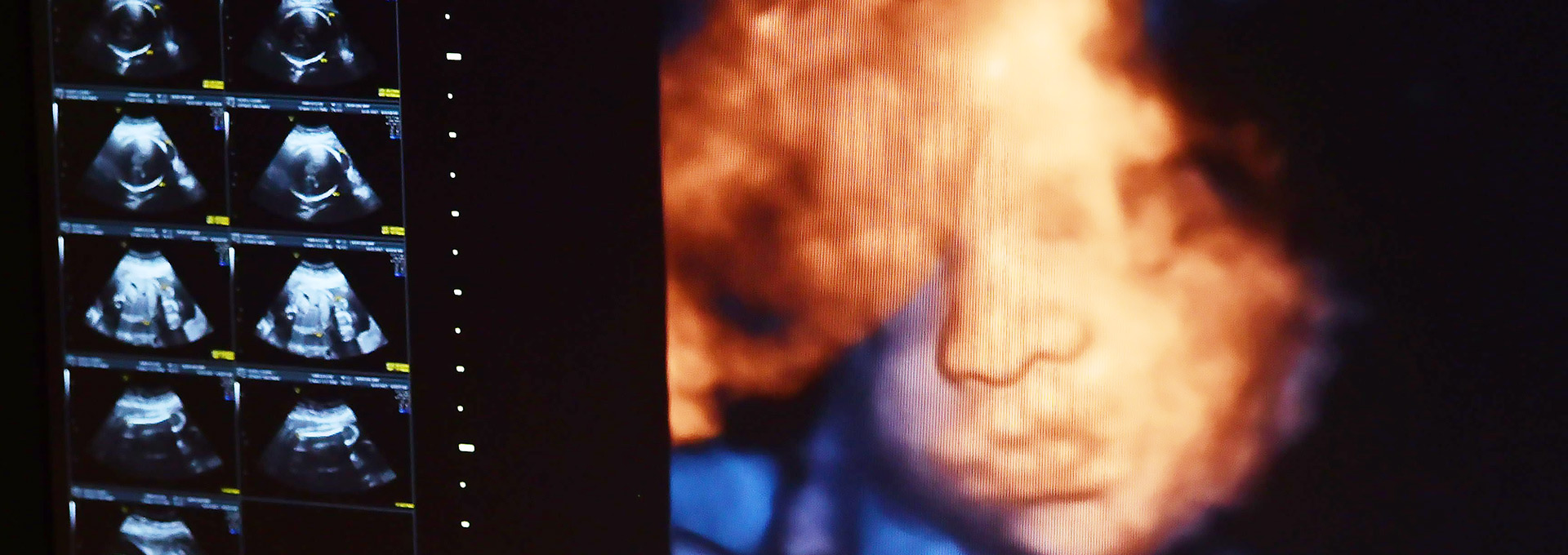 Imagem de ultrassonografia tridimensional, apresentando, em cores vivas, o rosto de um feto ainda no útero materno
