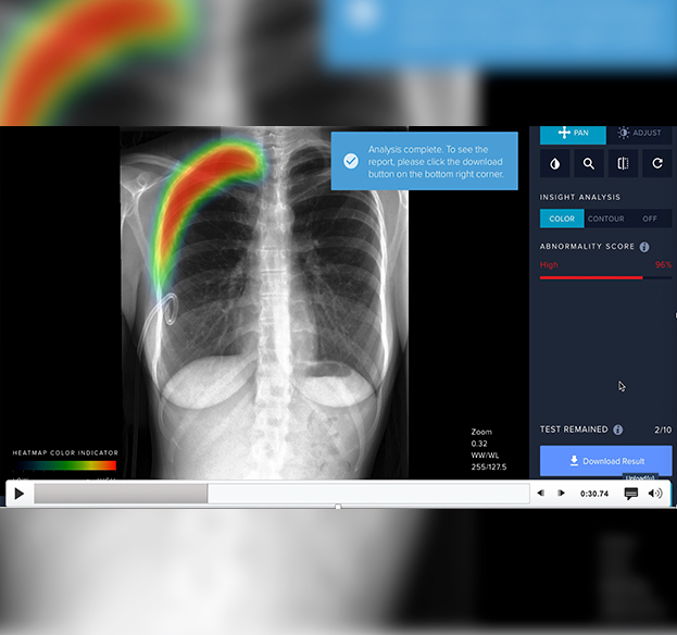 A startup desenvolveu um modelo de inteligência artificial capaz de detectar e localizar achados radiológicos em raio-x de pulmão Imagem de RX de um pulmão e vários comentários sobre o assunto