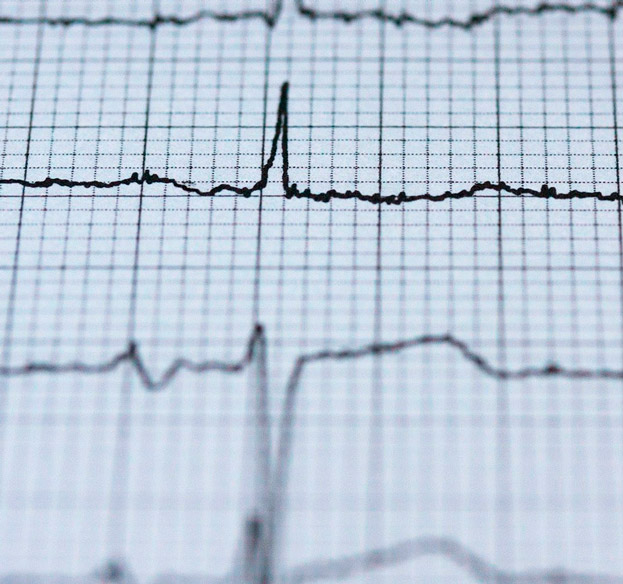 imagem de pulsos do coração realizados a partir de um eletrocardiograma 