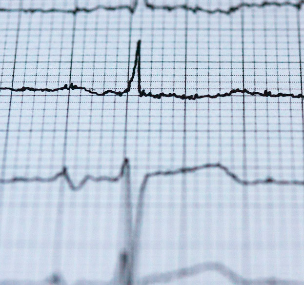 Empresa júnior desenvolve projeto com o potencial de salvar vidas das pessoas que precisam colocar um marca-passo imagem de pulsos do coração realizados a partir de um eletrocardiograma
