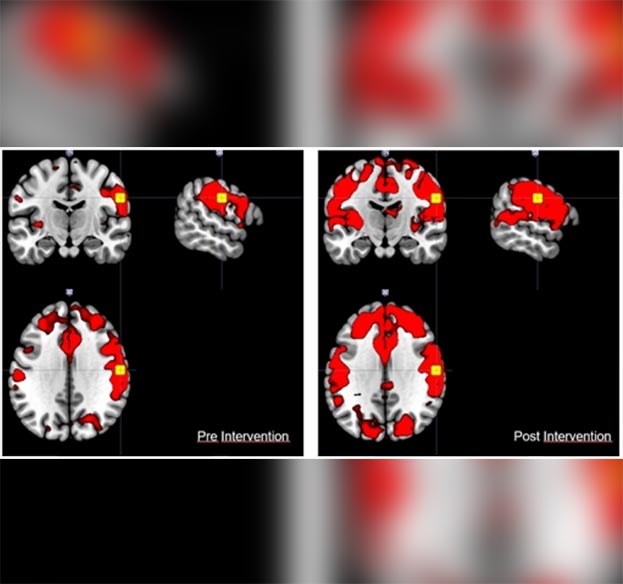 imagem de fMRI de um paciente com AVC antes e após reabilitação com o uso de software de realidade virtual não imersiva