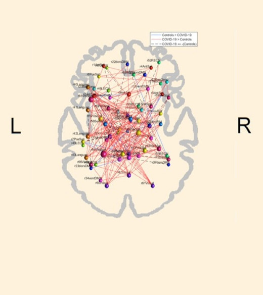 A Covid-19 – mesmo nos casos leves – pode alterar o padrão de conectividade funcional do cérebro, causando uma espécie de “curto-circuito” no órgão