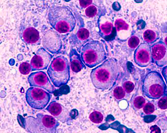 O mieloma múltiplo é o câncer das células da medula óssea que produzem anticorpos para o combate de vírus e bactérias, chamados de plasmócitos. Ilustração: Hemocentro da Unicamp
