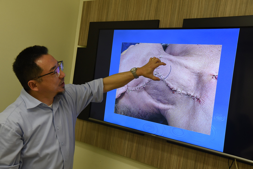 O médico Carlos Chone aponta na tela de uma TV à sua frente uma pequena incisão no pescoço, de no máximo 5cm (que aparece numa faixa em azul) para contrastar com o procedimento cirúrgico tradicional, em que os cortes cirúrgicos são extensos