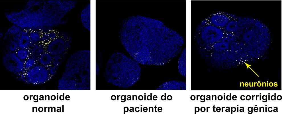 Imagens de microscopia mostrando o resultado do teste de terapia gênica para a Síndrome de Pitt-Hopkins, doença genética que compartilha características com os transtornos do espectro autista (TEA). Os organoides cerebrais de indivíduos não doentes (esquerda) apresentam neurônios em grande quantidade (células amarelas), diferentemente dos organoides derivados de crianças com a Síndrome de Pitt-Hopkins (imagem do meio). O tratamento do organoide cerebral doente com a terapia gênica levou ao reaparecimento dos neurônios (imagem da direita).