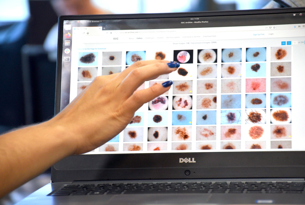 audiodescrição: fotografia colorida em zoom mostra detalhes das lesões de pele em uma tele de computador.