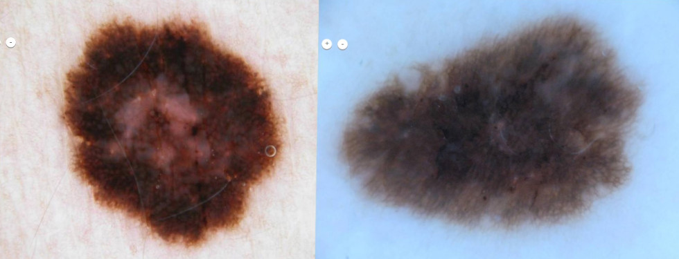 fotos mostram manchas de pele como exemplos de câncer de pele. à esquerda, um melanoma e à direita, uma mancha benigna