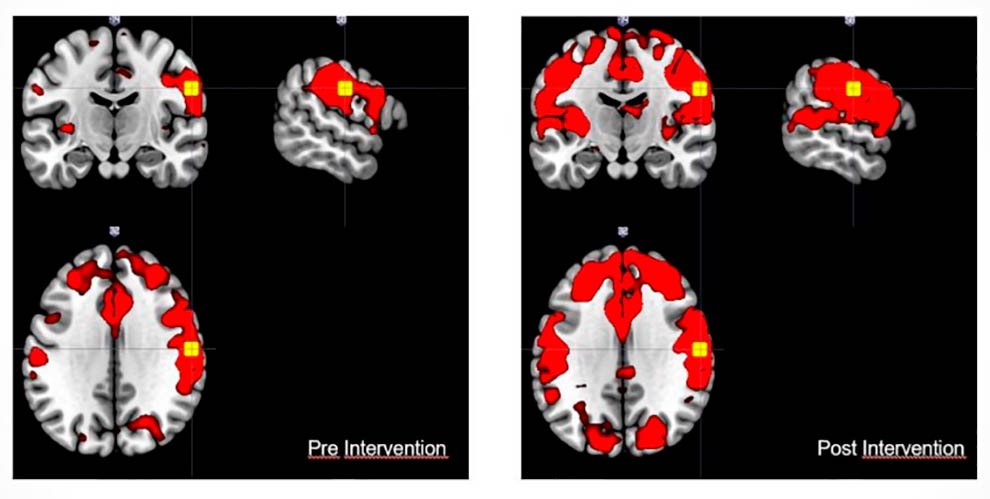 imagem mostra reproduções de ressonâncias magnéticas, na esquerda há áreas em vermelho menores e na direita as mesmas áreas são maiores