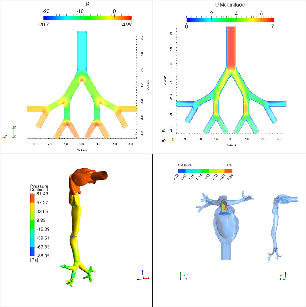 montagem mostra quatro imagens que reproduzem as condições da estrutura pulmonar, as duas de cima são mais simplificadas e as de baixo são reproduções de tomografias