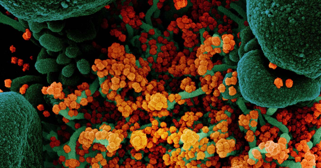 foto mostra micrografia eletrônica de células, em azul, contaminadas pelo coronavírus, em laranja