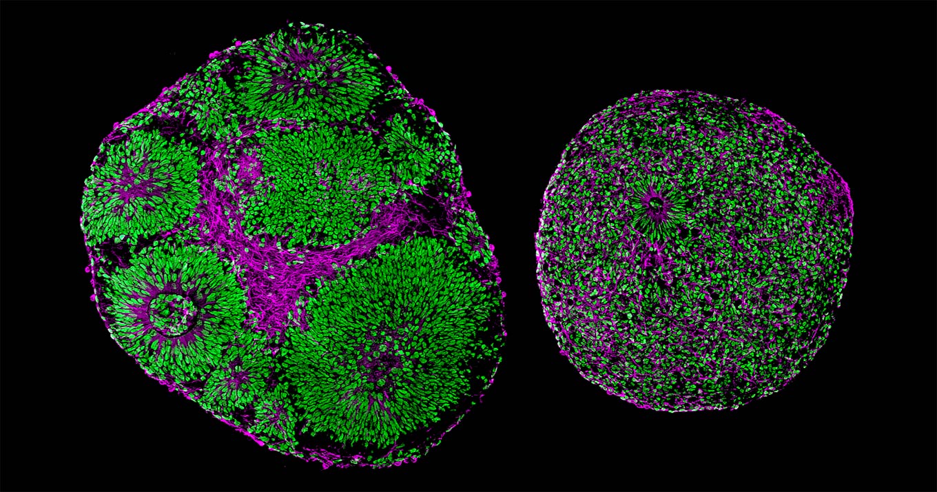 Imagens de microscopia mostrando organoides cerebrais derivados de um indivíduo não doente (esquerda) e de uma criança com a Síndrome de Pitt-Hopkins (direita). As células em verde são os progenitores de neurônios e as células em roxo são os neurônios. O tecido doente apresenta conteúdo bem menor desses dois tipos de células.
