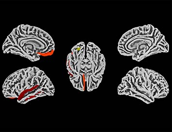 Imagem de recortes de cérebros com áreas marcadas em vermelho